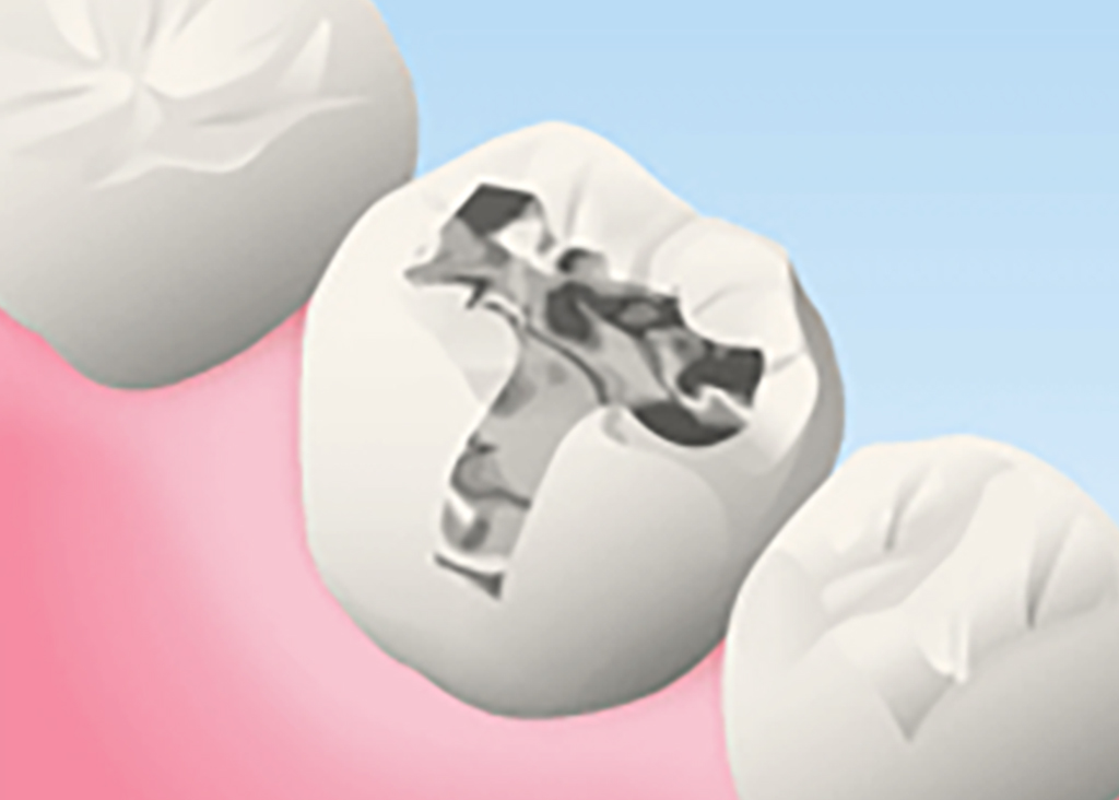 金銀パラジウム合金