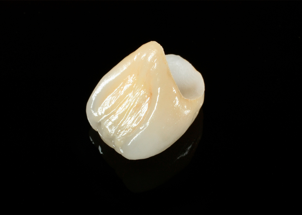 オールセラミック