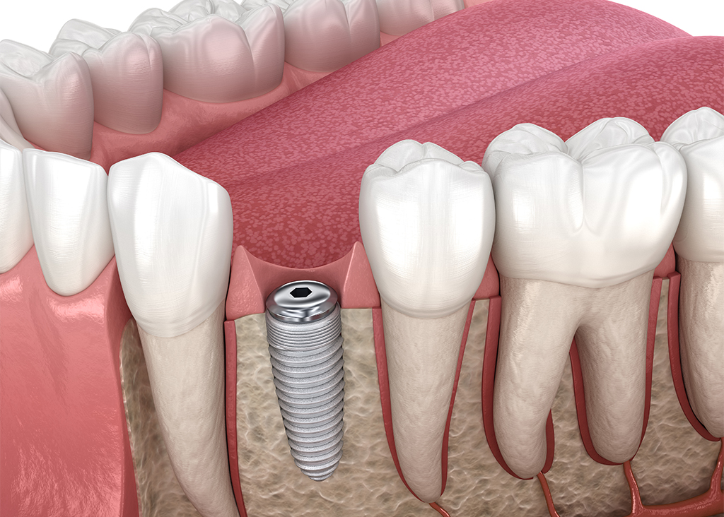 ヒーリングキャップを取り付ける（2次手術）