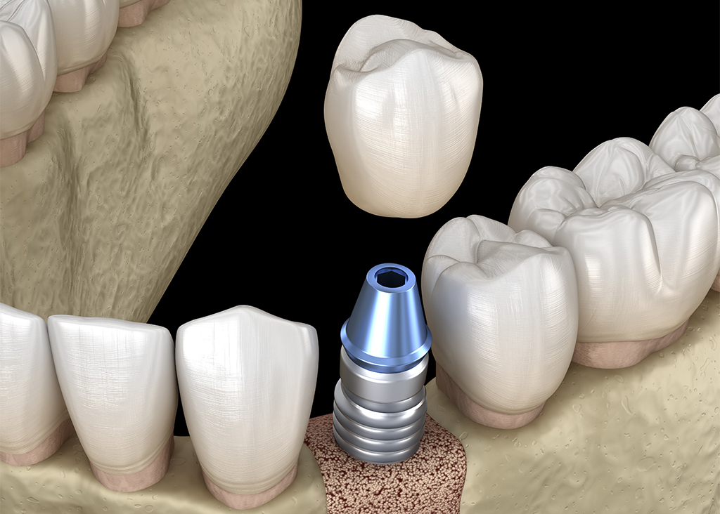 土台を立てて人工歯を被せる