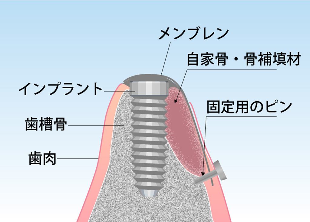 GBR（Guided Bone Regeneration：骨誘導再生法）