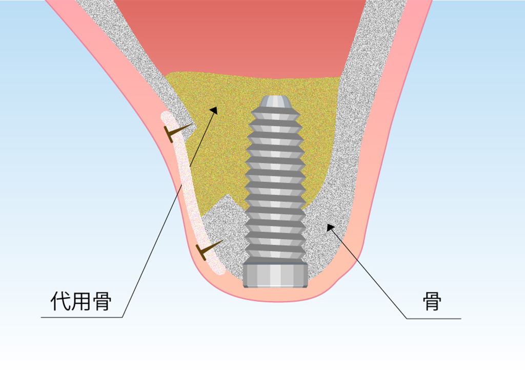 サイナスリフト