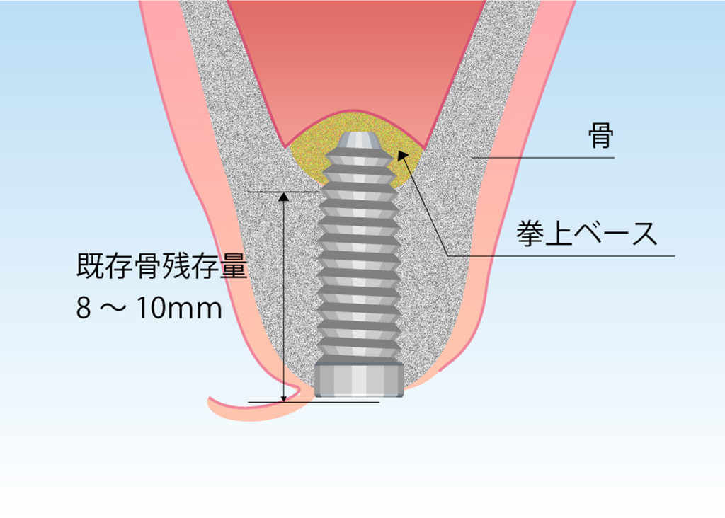 ソケットリフト