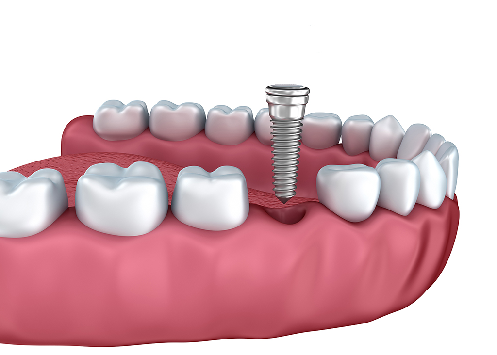 インプラント体を顎の骨に埋入（1次手術）